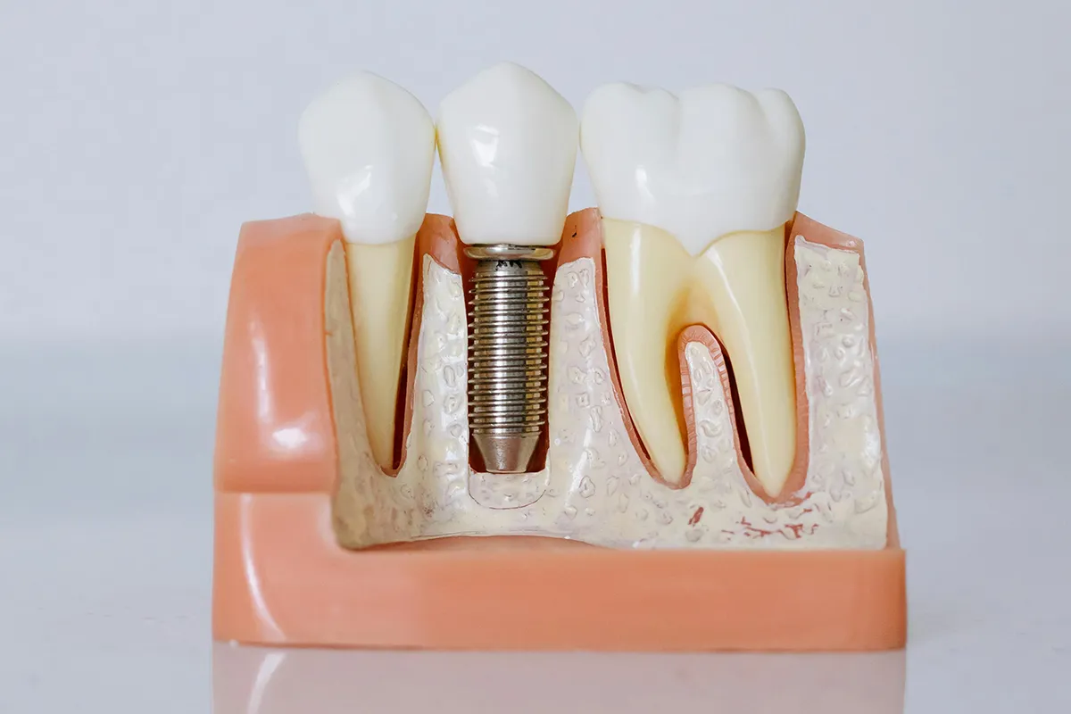 Dental Implants